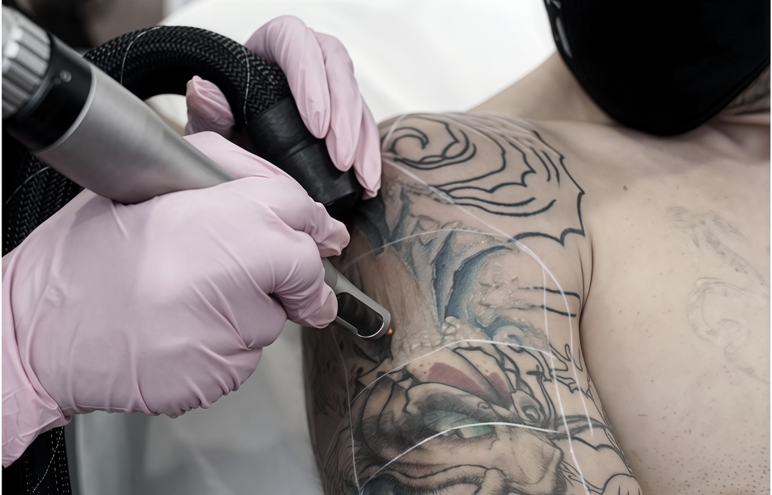 LASER TATTOO REMOVAL PAIN: WHAT TO EXPECT & HOW TO MANAGE IT