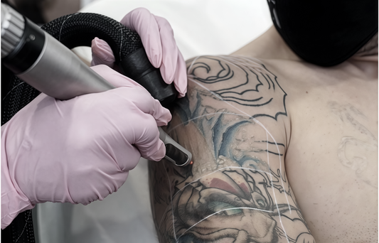 LASER TATTOO REMOVAL PAIN: WHAT TO EXPECT & HOW TO MANAGE IT